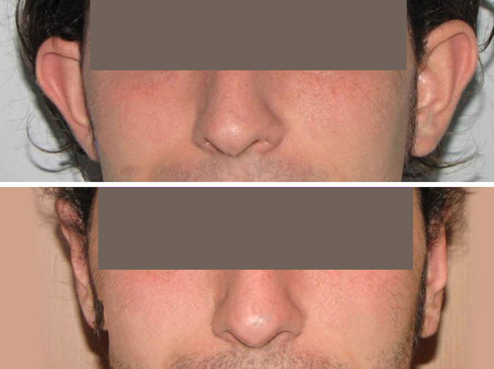 otoplastica - chirurgia estetica viso